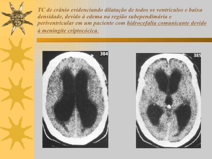 Exame meningite