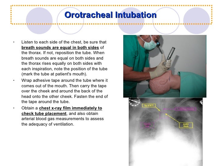 Airway Management