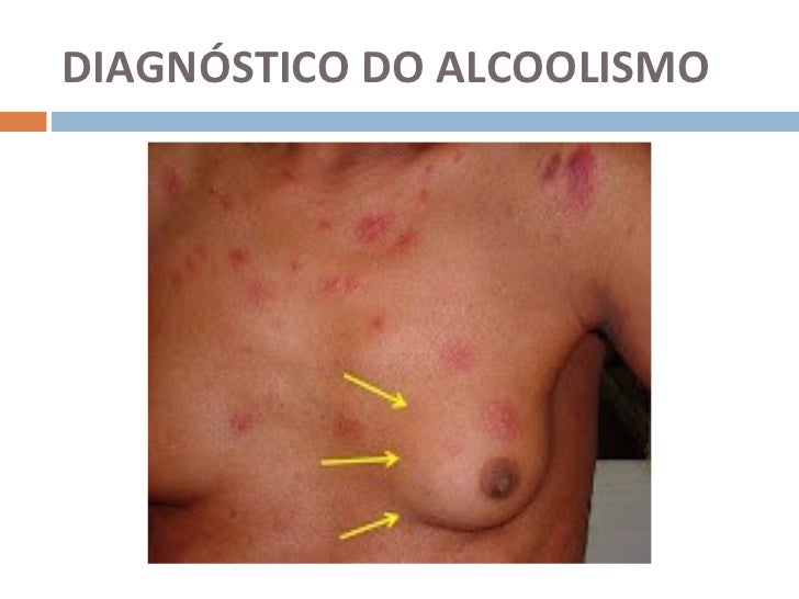Codificação de remédios de alcoolismo