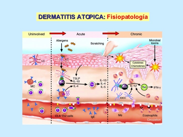 La crema la celidonia mayor a la psoriasis
