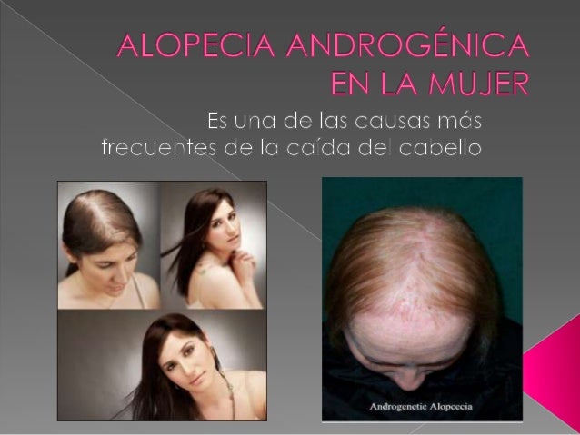 La alopecia en 25 años de la foto