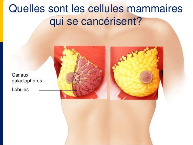 Alimentation malade cancer lymphome grade 4
