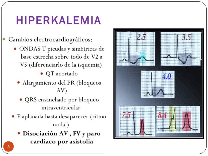 Alteraciones electrolíticas en el electrocardiograma
