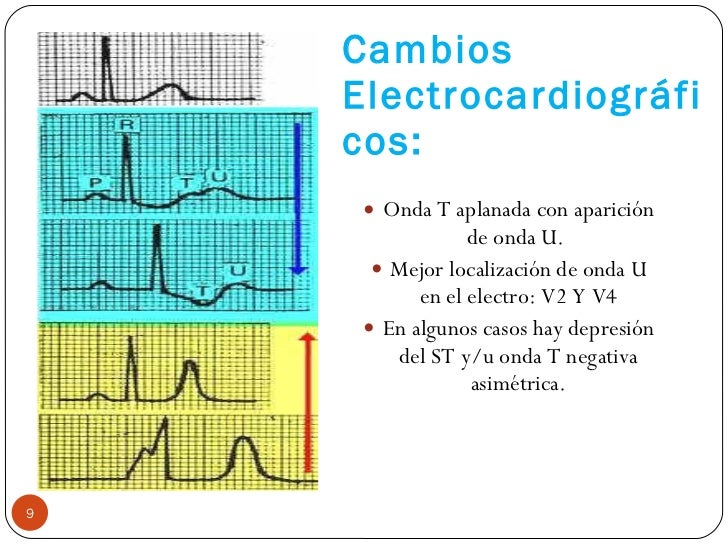 Alteraciones electrolíticas en el electrocardiograma