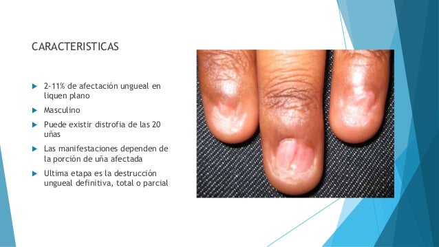 El envolvimiento para el adelgazamiento del vientre en las condiciones de casa por el vinagre