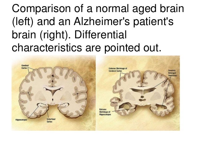 the characteristics of alzheimers disease a progressive brain disorder Brain with alzheimer’s disease this computer graphic compares the brain of a patient with alzheimer’s disease, left, with a normal, healthy brain, right a degenerative disease, alzheimer’s disease causes brain tissue to shrink and leads to a gradual, irreversible loss of memory and language ability encarta encyclopedia alfred pasieka/science photo library/photo researchers, inc. the characteristics of alzheimers disease a progressive brain disorder Brain with alzheimer’s disease this computer graphic compares the brain of a patient with alzheimer’s disease, left, with a normal, healthy brain, right a degenerative disease, alzheimer’s disease causes brain tissue to shrink and leads to a gradual, irreversible loss of memory and language ability encarta encyclopedia alfred pasieka/science photo library/photo researchers, inc.