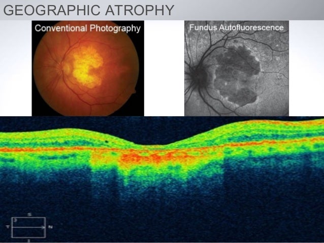 Resultado de imagen de geographic atrophy