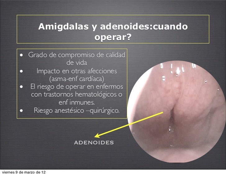Amigdalas y adenoides
