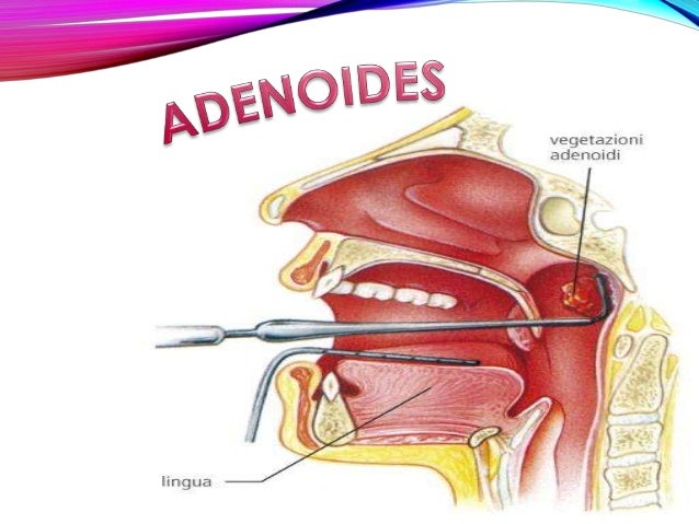 Amigdalas y adenoides
