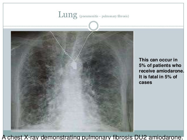 Amiodarone Toxicity Testing