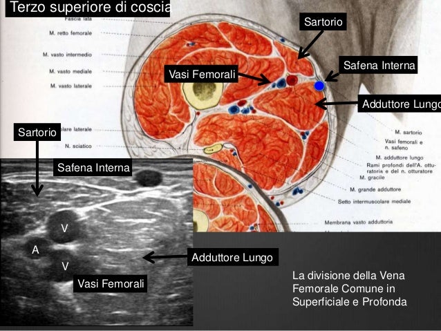 Le emorroidi croniche 2 gradi complicate da trombosi