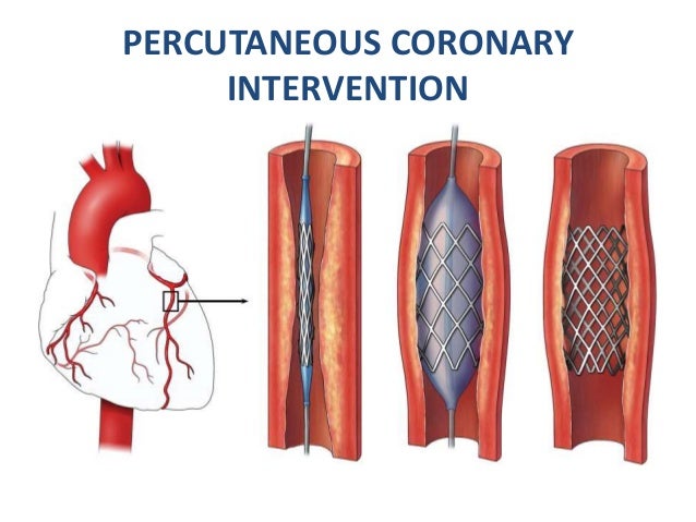 Anatomical basis of coronary intervention Anatomical basis of coronary intervention