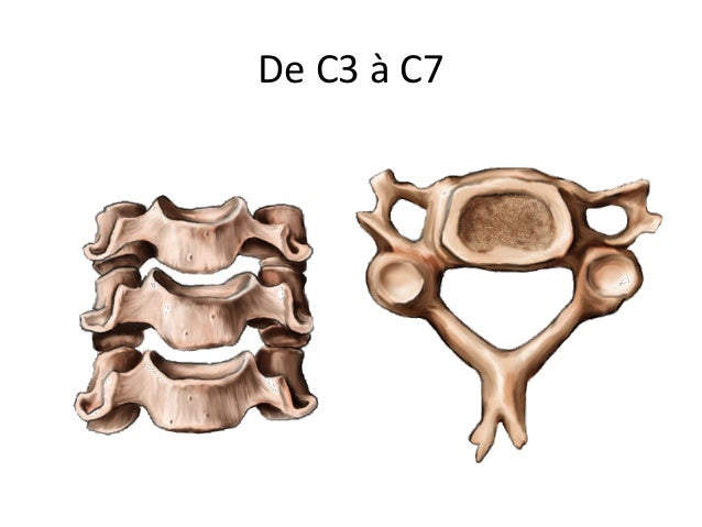 Metastase Vertebres Cervicales