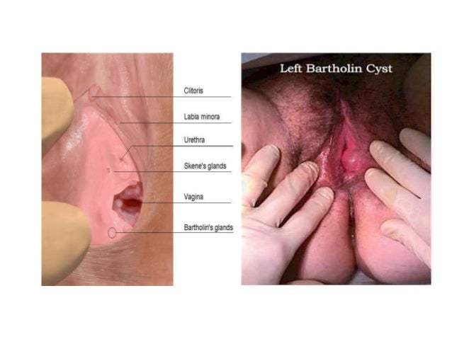 Blood blisters near vagina