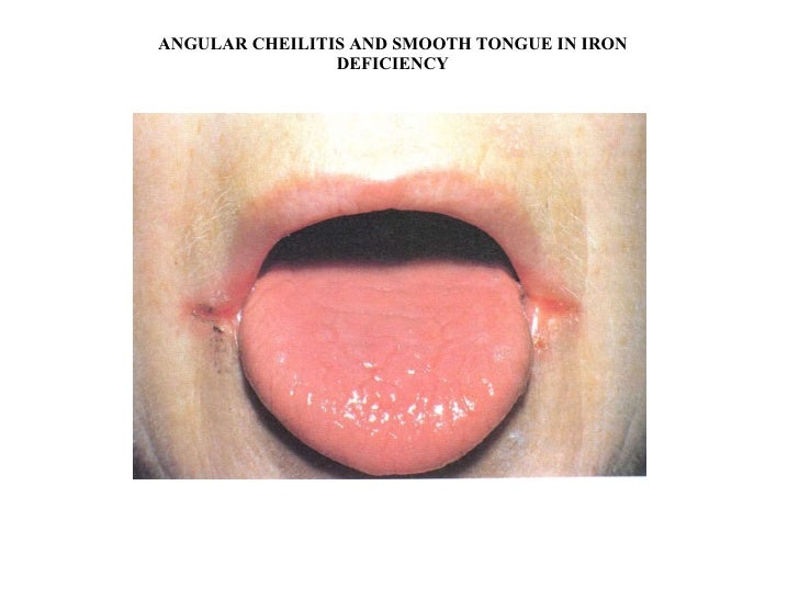 Iron Deficiency...