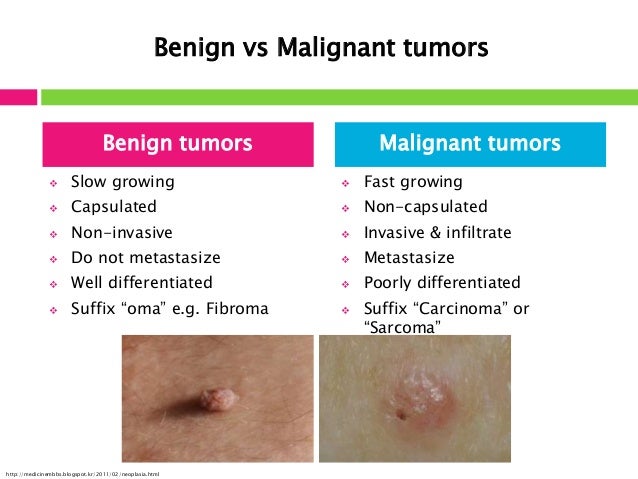 The Treatment Of A Malignant Tumor