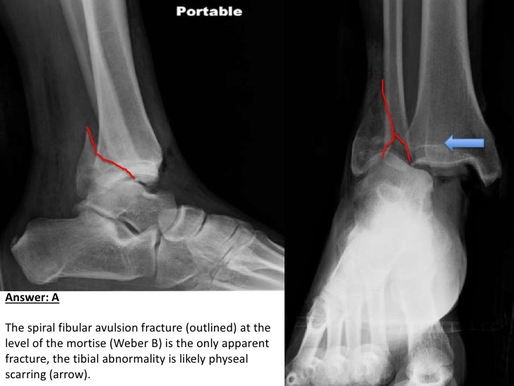 lateral malleolus fracture bruising lateral malleolus fracture bruising