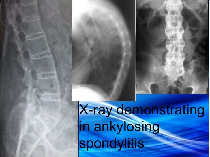 Ankylosing spondylitis immunosuppressive drug image