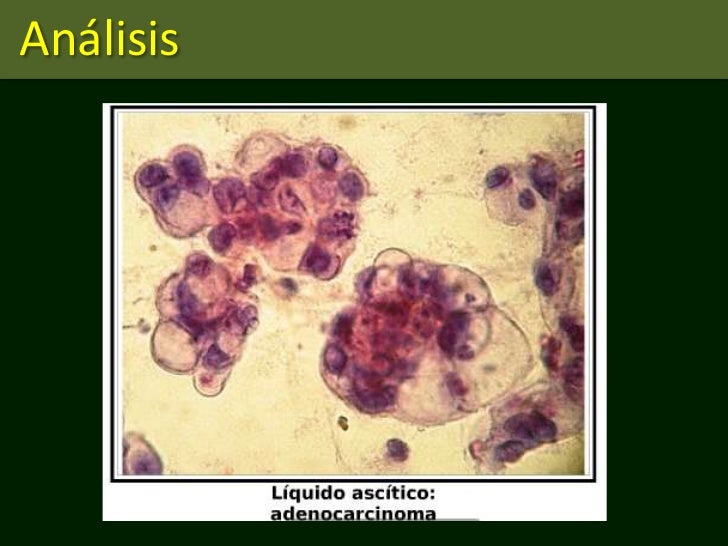 Análisis de líquido peritoneal