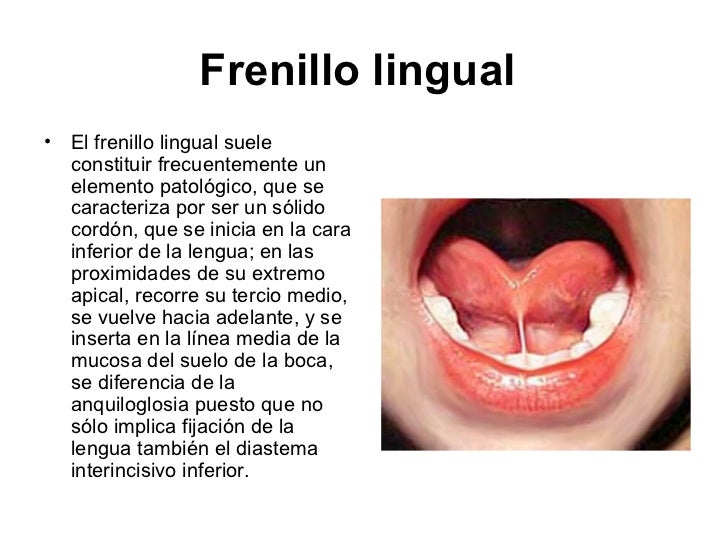 Anomalías del desarrollo de la lengua