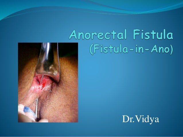 Anal fistula plug