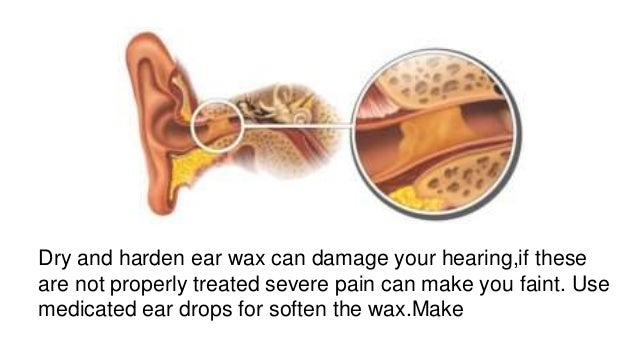 Ear Wax Removal Drops For Glue Ear 37