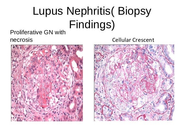 Kidney Transplant remedy