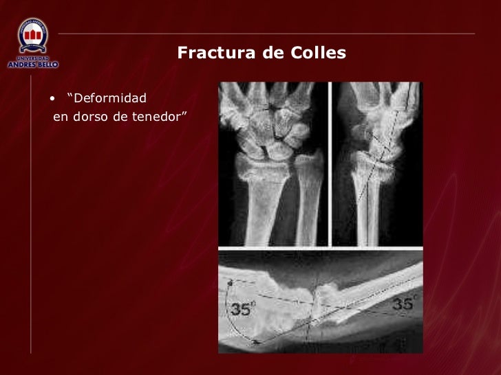 Antebrazo, Codo Y Brazo Por Trauma