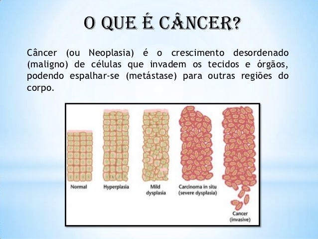 Cancer Os Metastase
