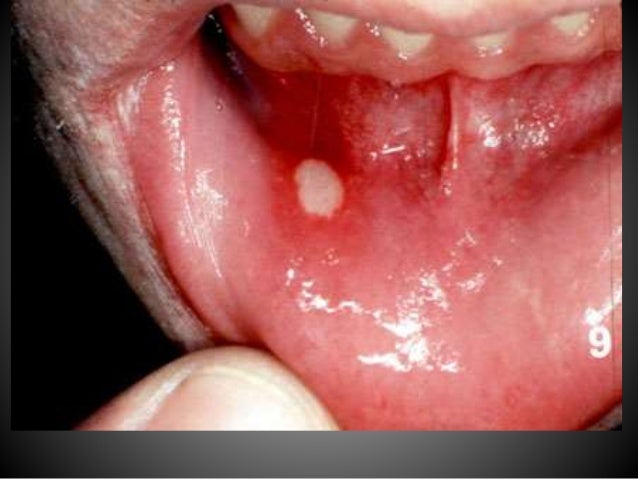 Mouth ulcer - Wikipedia