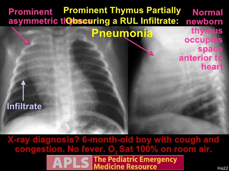 A P L S Pediatric Emergency Radiology 1
