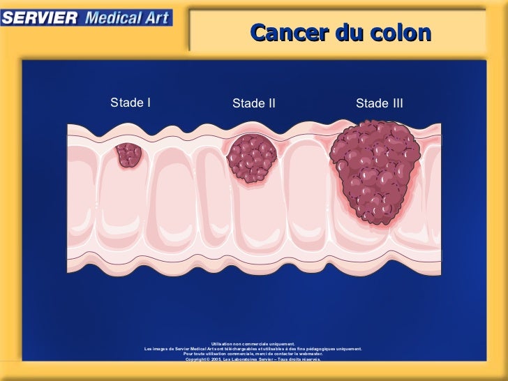 symptome du cancer d'estomac