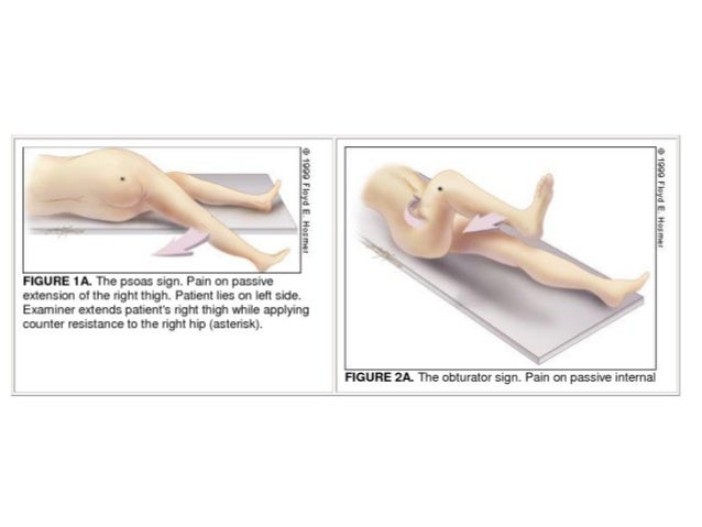 appendectomy appendicitis and appendix the appendix Appendicitis, or inflammation of the appendix, has many different causes pain in the abdomen is the most common symptom of appendicitis, but you also may experience. appendectomy appendicitis and appendix the appendix Appendicitis, or inflammation of the appendix, has many different causes pain in the abdomen is the most common symptom of appendicitis, but you also may experience.