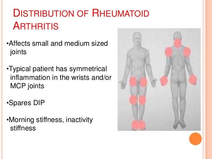 Approach to case of arthritis