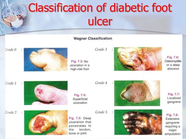 Diabetic Foot Ulcer - WebMD