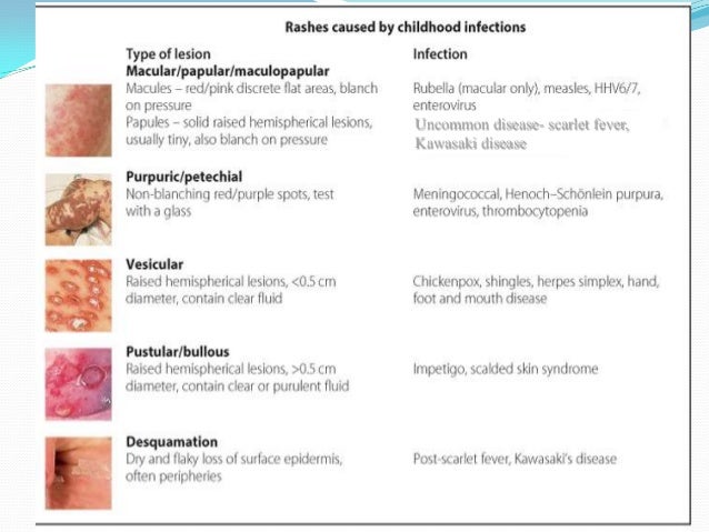 Rash | Dermatitis | Skin Rash - MedlinePlus: Rashes