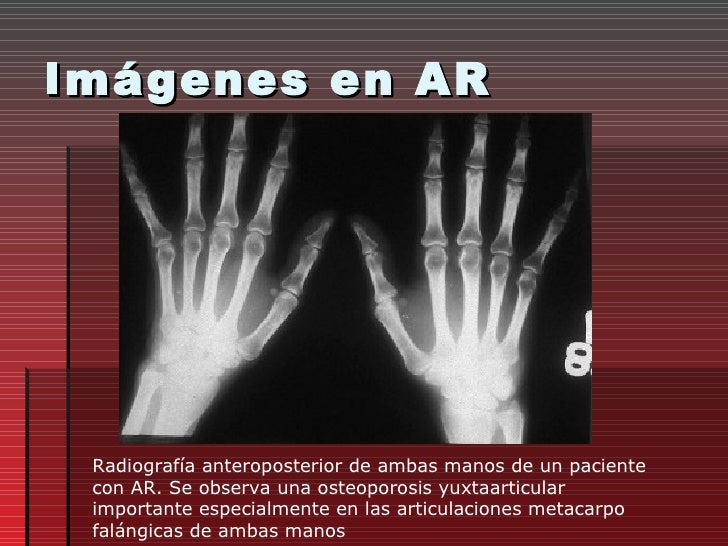 Artritis Reumatoide Artritis Reumatoide