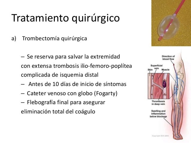 Los trombos de las venas profundas de los pies el tratamiento