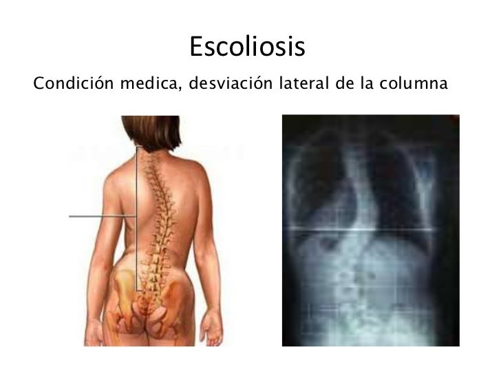 Duele el lado de la parte izquierda de la espalda con la parte inferior