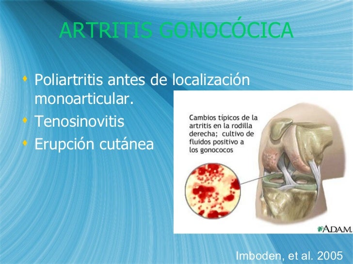 Artritis Gotosa