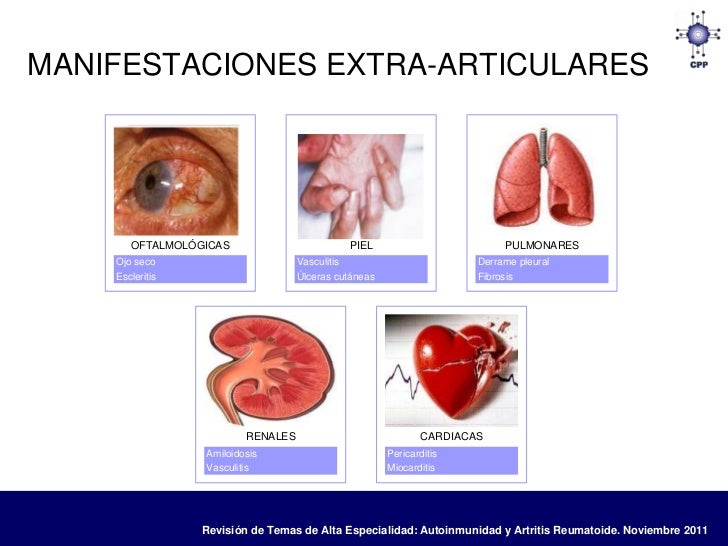artritis reumatoide leve