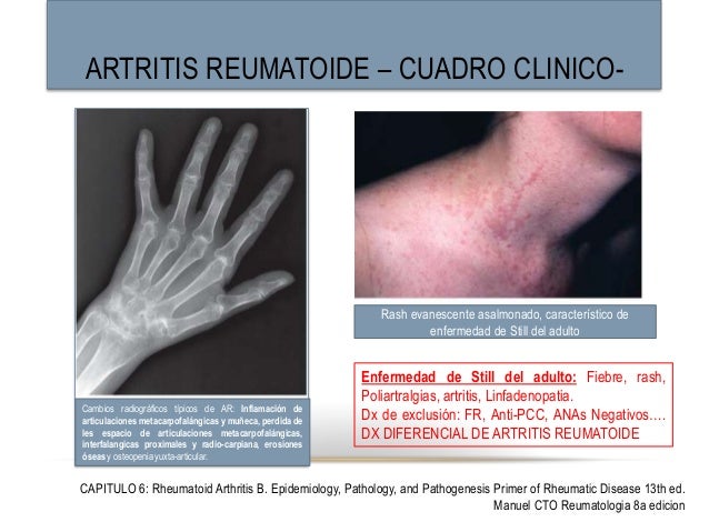 artritis reumatoide cuadro clinico artritis reumatoide artritis reumatoide cuadro clinico artritis reumatoide