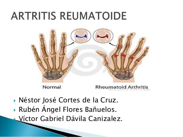 que significa artritis reumatoide