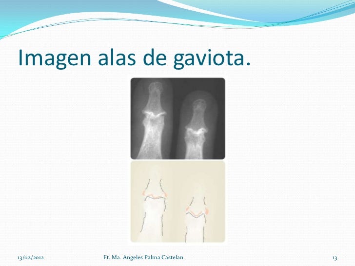 Artropatias