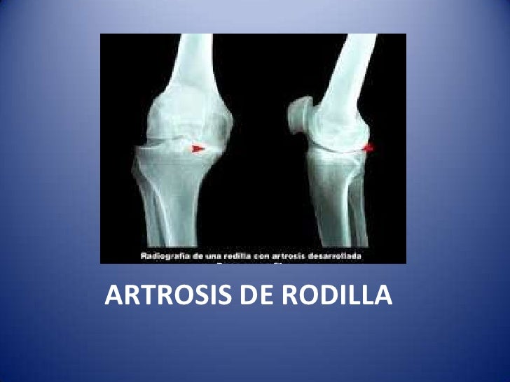 Causas De La Artritis