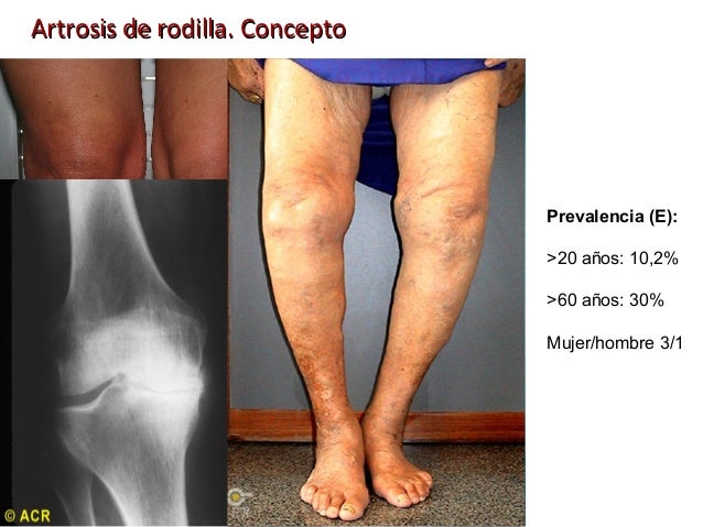 Artrosis rodilla 2012