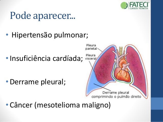 Cancer Pleural Sintomas