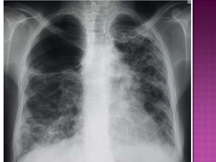 what is asbestos siding