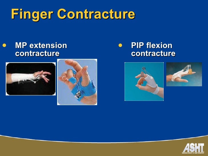 Ashtca chapter splinting