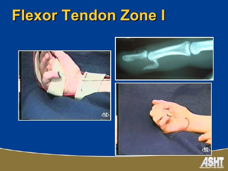 Ashtca chapter splinting
